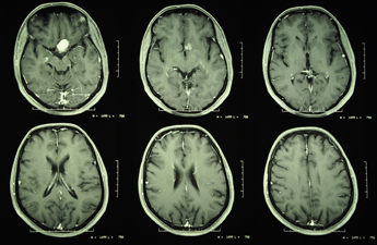 What is the likely outcome of a benign meningioma?